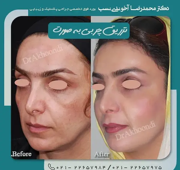 عکسهای قبل و بعد از تزریق چربی صورت