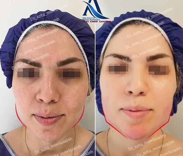 عکسهای قبل و بعد تزریق چربی صورت