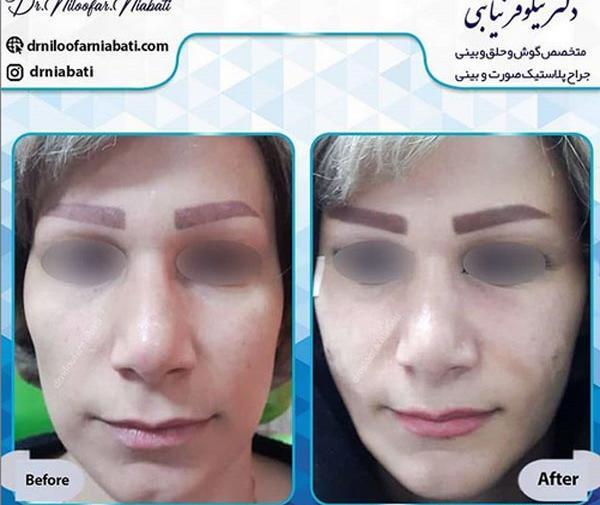 عکسهای قبل و بعد تزریق چربی صورت