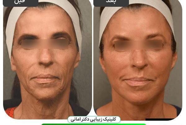 عکسهای قبل و بعد تزریق چربی صورت