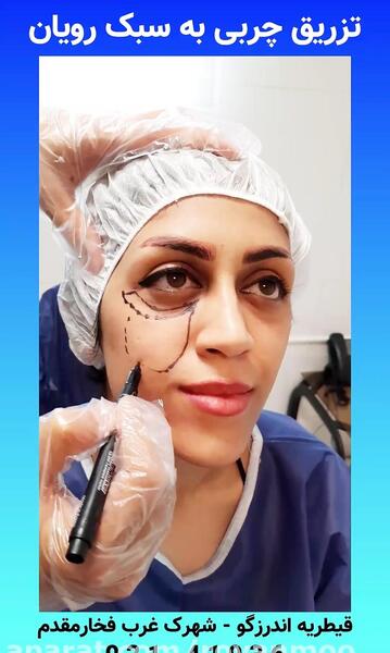 عکسهای قبل و بعد تزریق چربی صورت