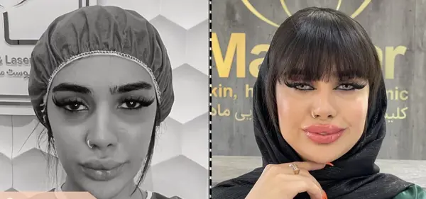 عکسهای قبل و بعد تزریق چربی صورت
