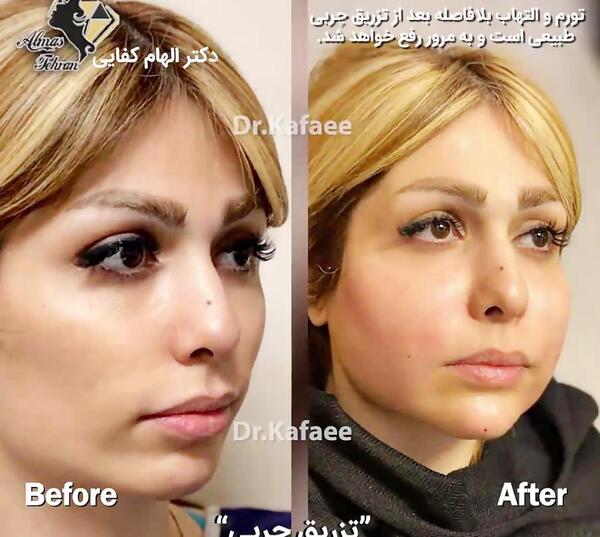 عکسهای قبل و بعد تزریق چربی صورت