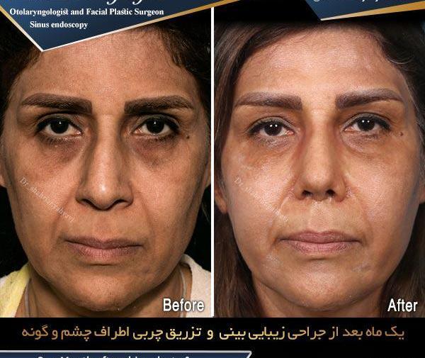عکسهای قبل و بعد تزریق چربی صورت