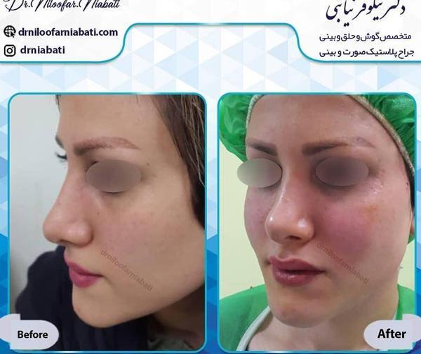 عکسهای قبل و بعد تزریق چربی صورت