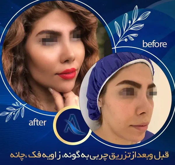 عکسهای قبل و بعد تزریق چربی صورت