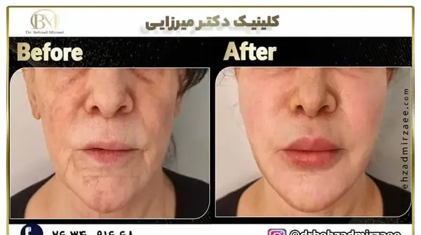 عکسهای قبل و بعد تزریق چربی صورت