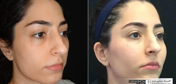 عکسهای قبل و بعد تزریق چربی صورت
