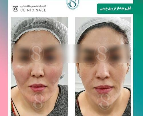عکسهای قبل و بعد تزریق چربی صورت