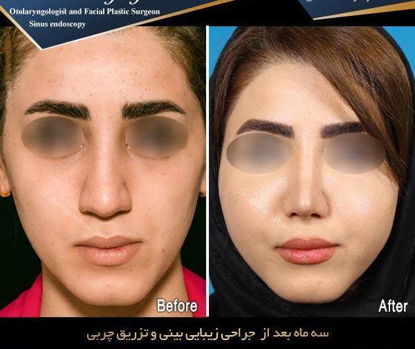 عکسهای قبل و بعد تزریق چربی صورت