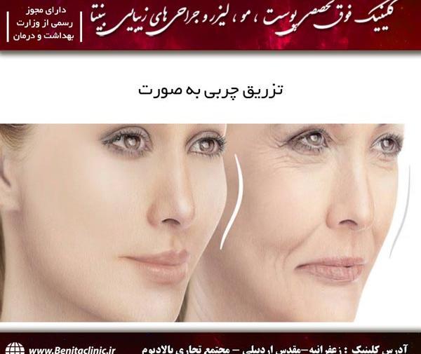 عکسهای قبل و بعد تزریق چربی صورت