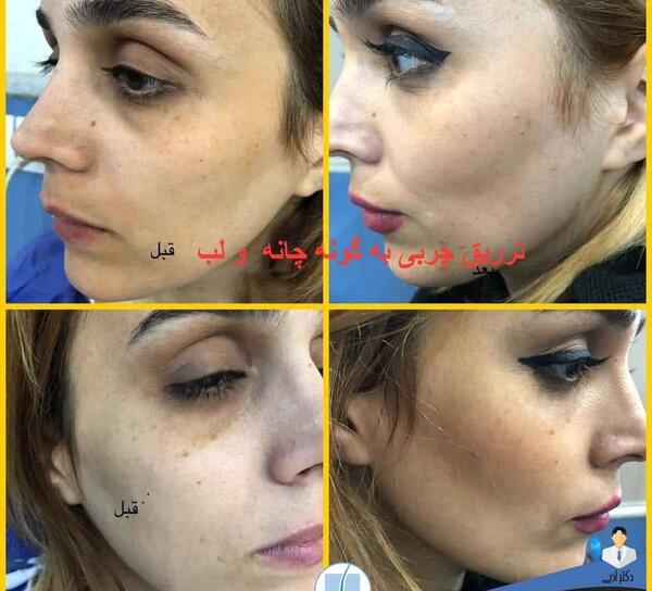 عکسهای قبل و بعد تزریق چربی صورت