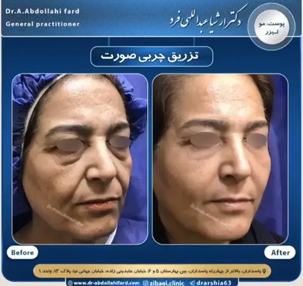 عکسهای قبل و بعد تزریق چربی صورت