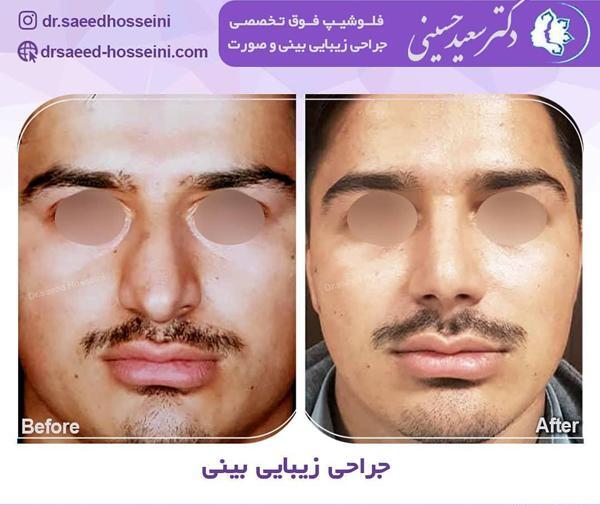 عکس قبل و بعد عمل بینی گوشتی مردانه