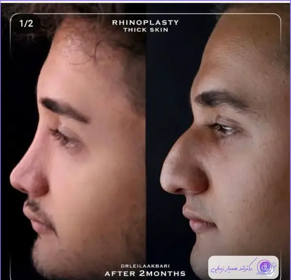 عکس قبل و بعد عمل بینی گوشتی مردانه