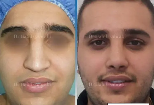 عکس قبل و بعد عمل بینی گوشتی مردانه