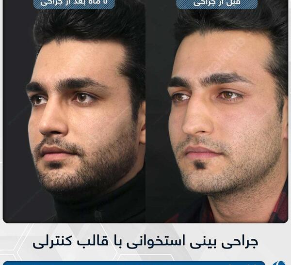 عکس قبل و بعد عمل بینی گوشتی مردانه