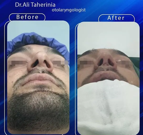 عکس قبل و بعد عمل بینی گوشتی مردانه