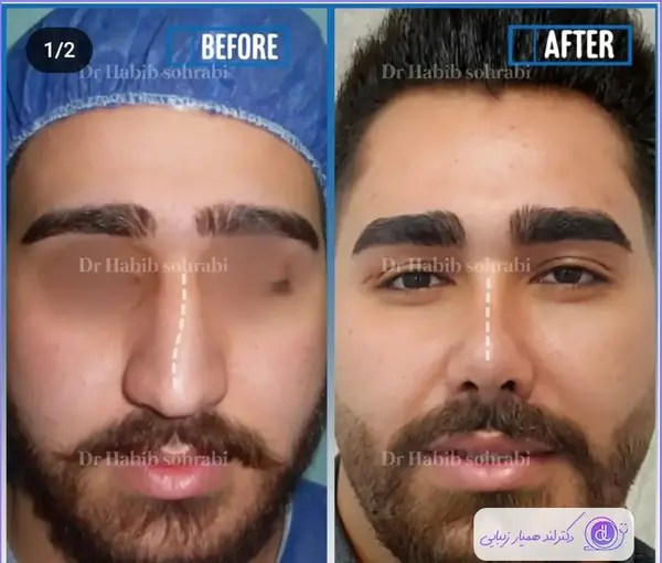 عکس قبل و بعد عمل بینی گوشتی مردانه