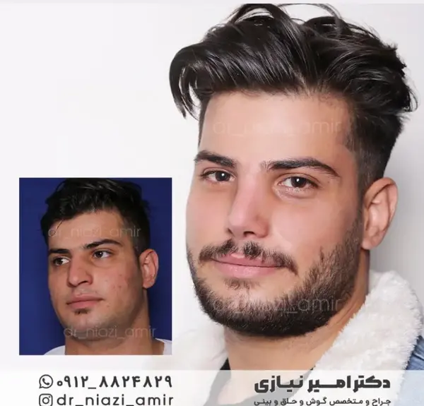 عکس قبل و بعد عمل بینی گوشتی مردانه