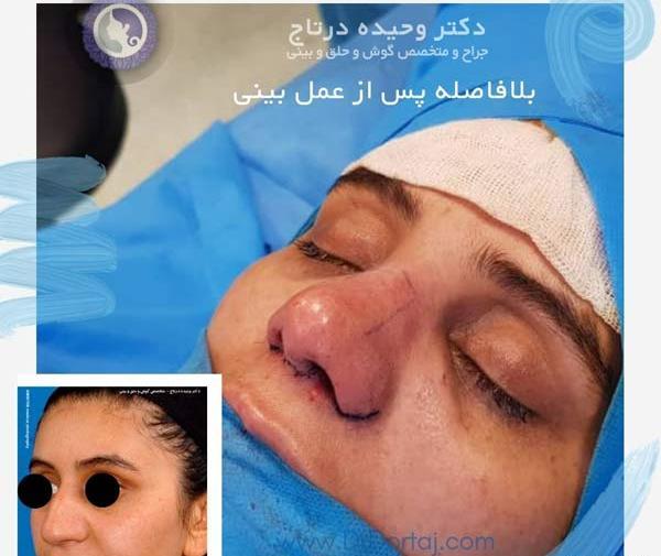 عکس قبل و بعد عمل بینی گوشتی مردانه