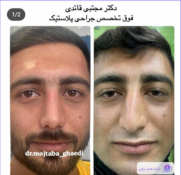 عکس قبل و بعد عمل بینی گوشتی مردانه