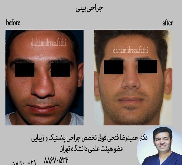 عکس قبل و بعد عمل بینی گوشتی مردانه