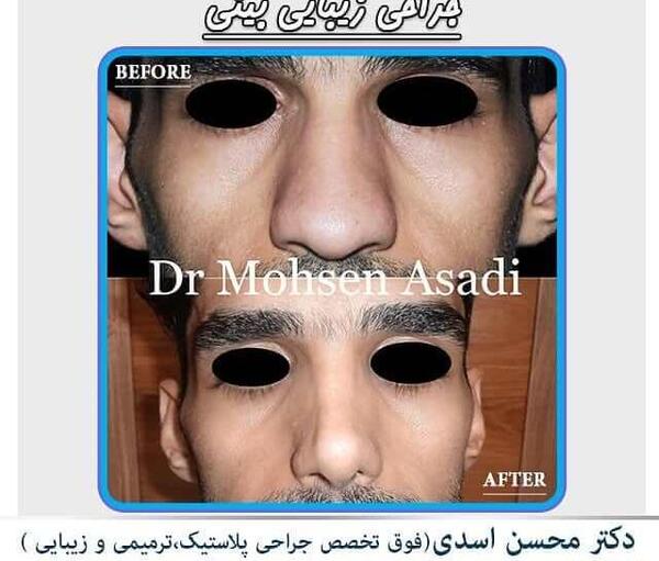 عکس قبل و بعد عمل بینی گوشتی مردانه