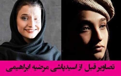 عکس مرضیه ابراهیمی قبل از اسید پاشی