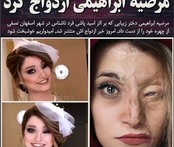 عکس مرضیه ابراهیمی قبل از اسید پاشی