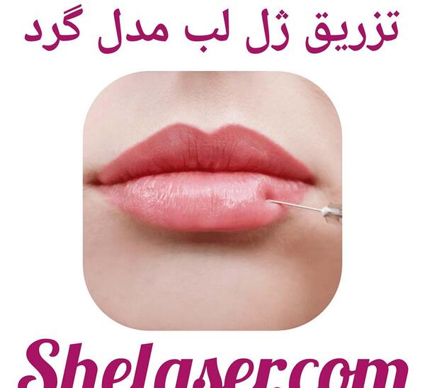 عکس پروتز لب قبل و بعد