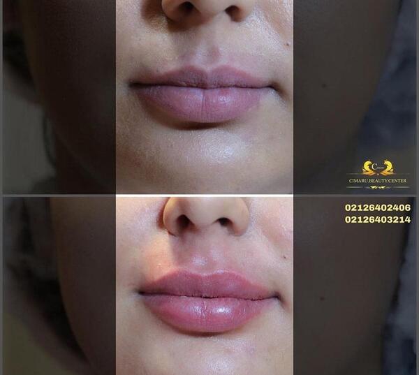عکس پروتز لب قبل و بعد