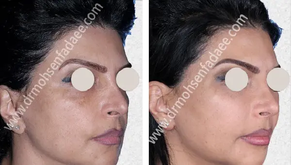 عکس پروتز لب قبل و بعد
