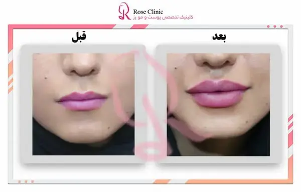 عکس پروتز لب قبل و بعد