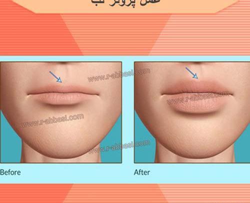 عکس پروتز لب قبل و بعد