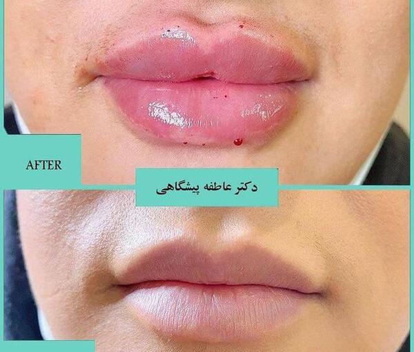 عکس پروتز لب قبل و بعد