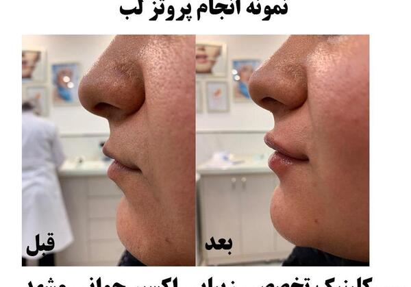 عکس پروتز لب قبل و بعد