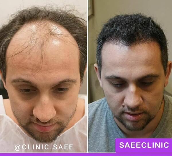 عکس تراشتگن قبل از کاشت مو