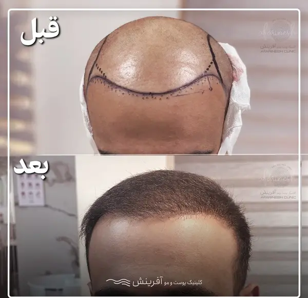عکس تراشتگن قبل از کاشت مو
