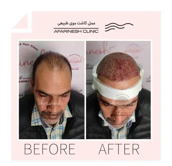 عکس تراشتگن قبل از کاشت مو