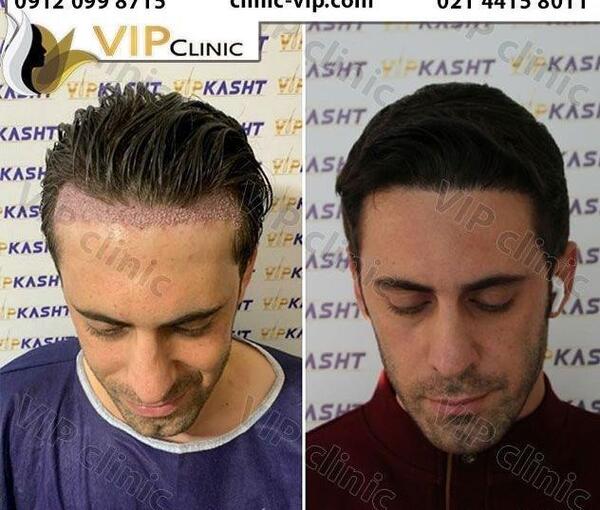 عکس تراشتگن قبل از کاشت مو