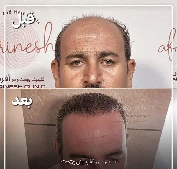 عکس تراشتگن قبل از کاشت مو