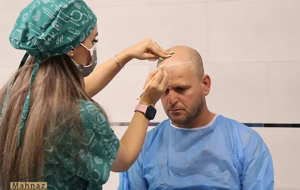 عکس قبل و بعد از کاشت مو