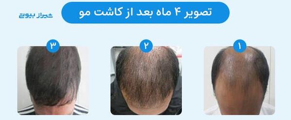 عکس قبل و بعد از کاشت مو