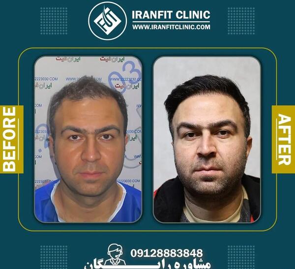 عکس قبل و بعد از کاشت مو