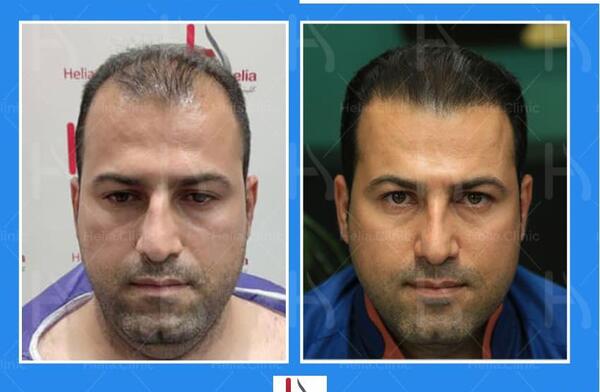 عکس قبل و بعد از کاشت مو