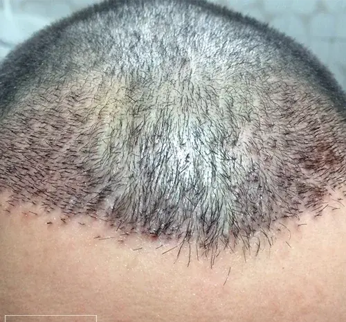 عکس قبل و بعد از کاشت مو