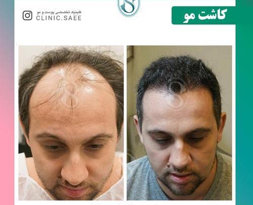 عکس قبل و بعد از کاشت مو