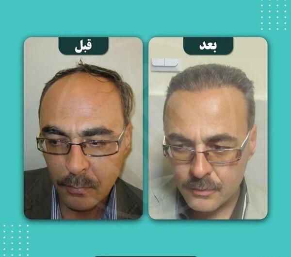 عکس قبل و بعد از کاشت مو