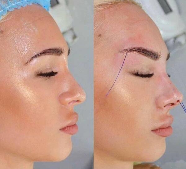 عکس قبل و بعد لیفت مژه و ابرو